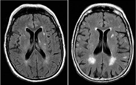 brain scan of dementia patient who may have drank a lot of alcohol