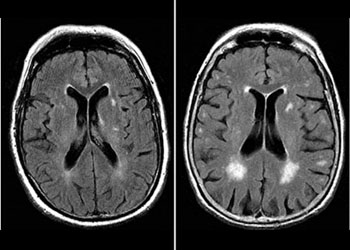 Brain suffering from dementia